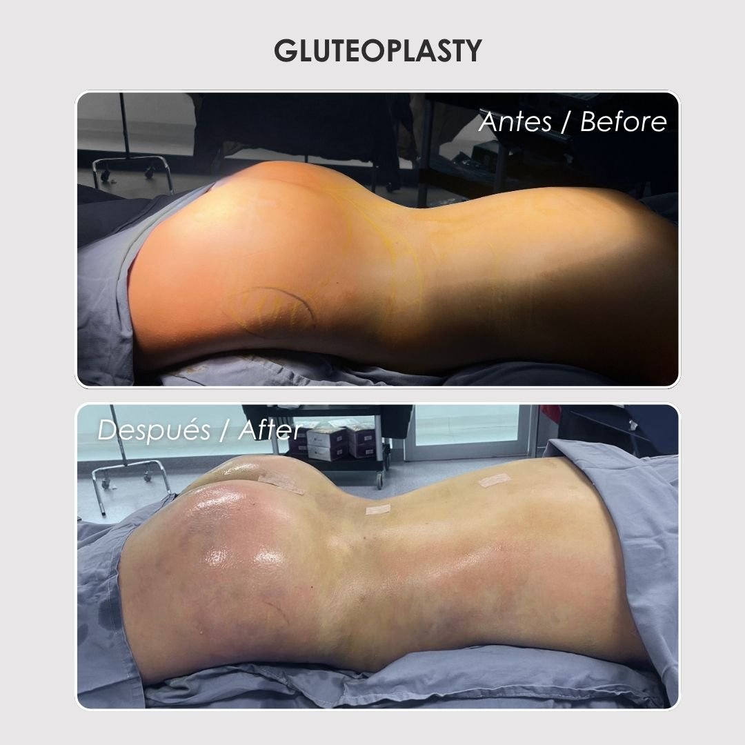 Gluteoplasty - colombian plastic surgery before and after - Dr. Daniela Correa