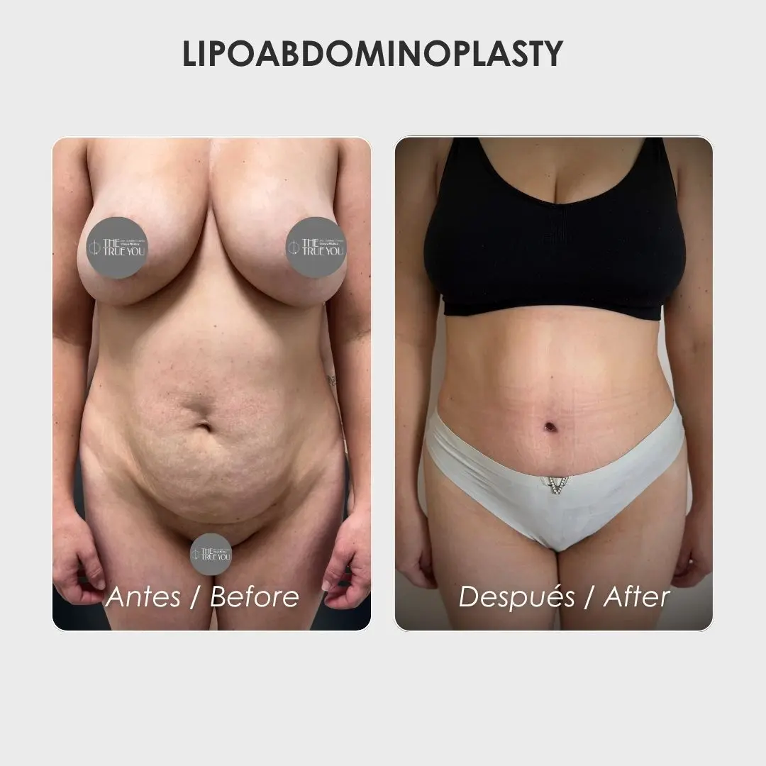 Lipoabdominoplasty - colombian plastic surgery before and after - Dr. Daniela Correa 3