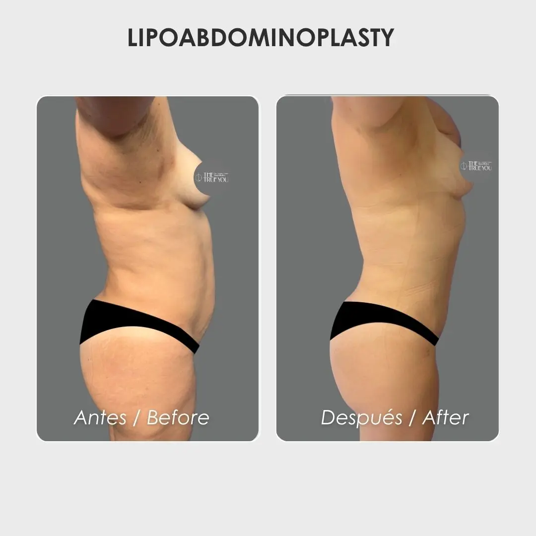 Lipoabdominoplasty - colombian plastic surgery before and after - Dr. Daniela Correa 4