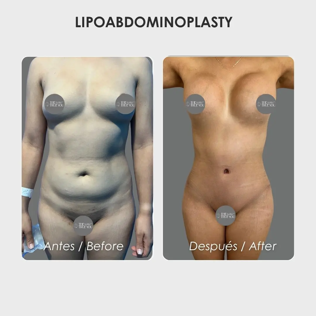 Lipoabdominoplasty - colombian plastic surgery before and after - Dr. Daniela Correa 5