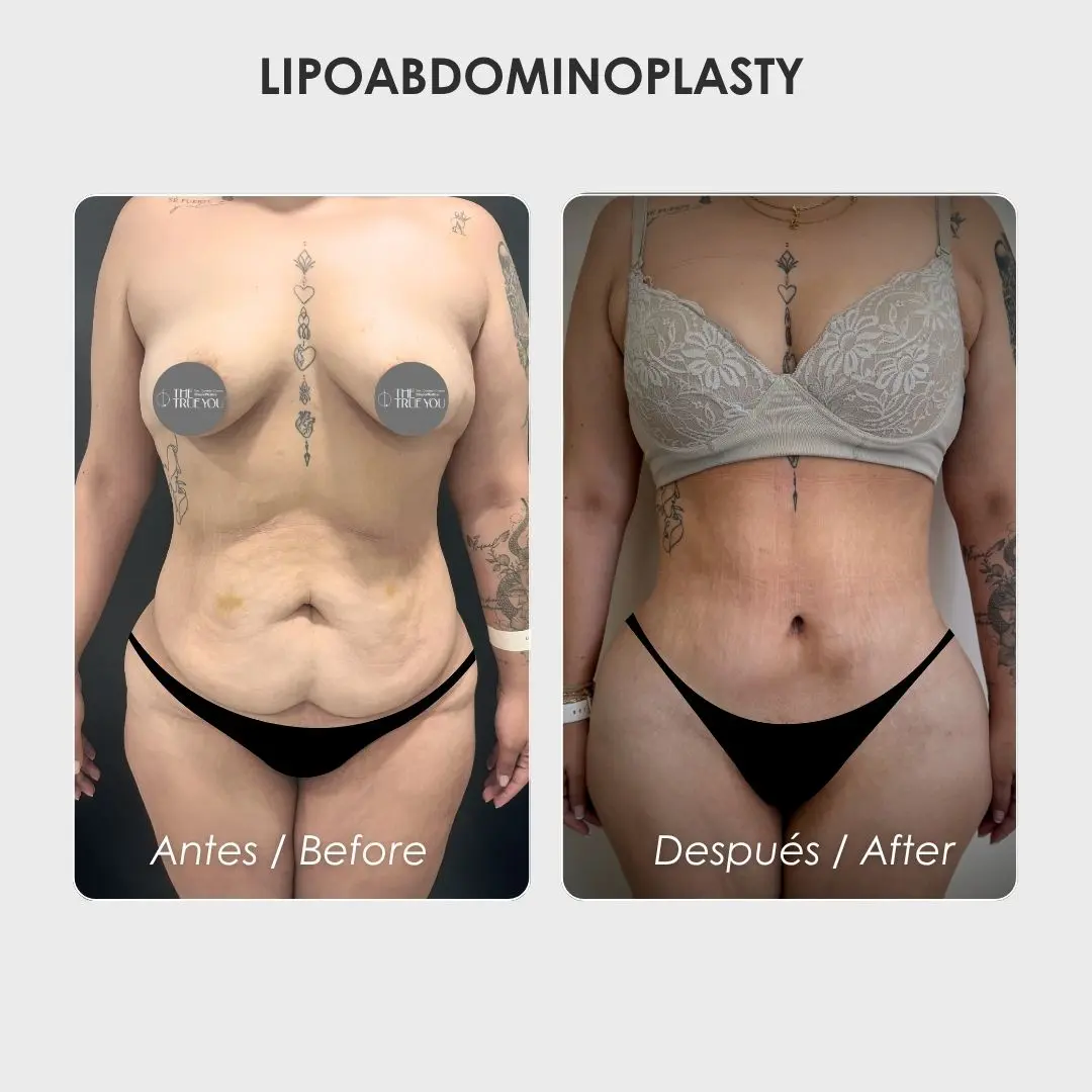 Lipoabdominoplasty - colombian plastic surgery before and after - Dr. Daniela Correa