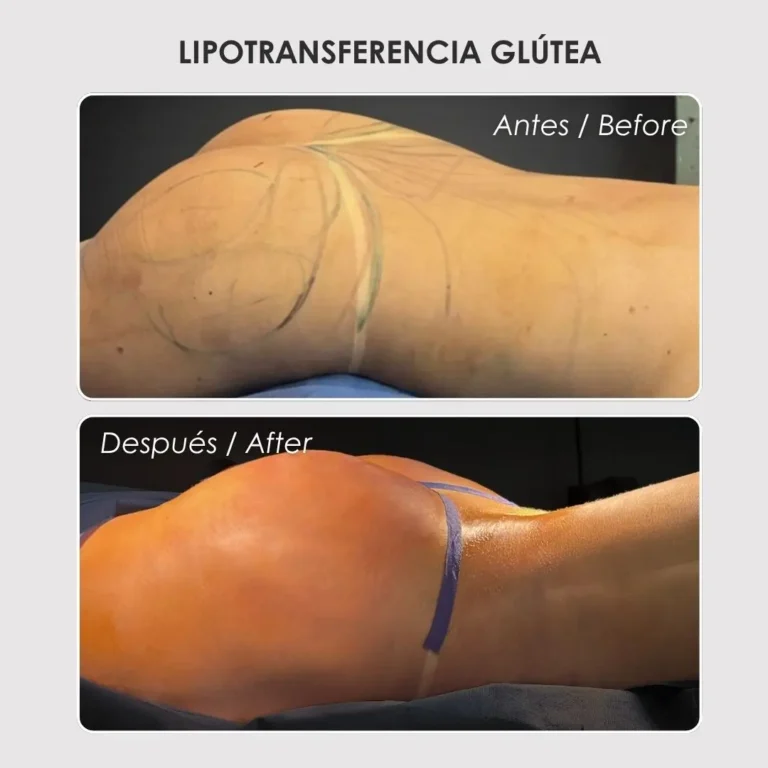 Lipotransferencia glútea antes y después con la cirujana plástica Daniela Correa - Medellín , Colombia- 060426