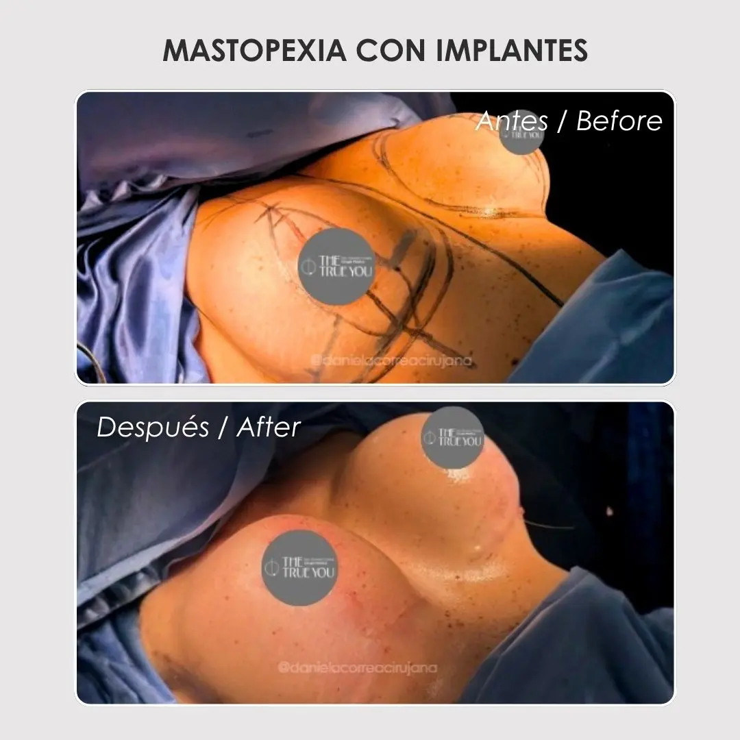 Mastopexia antes y después con la cirujana plástica Daniela Correa - Medellín , Colombia- 060426