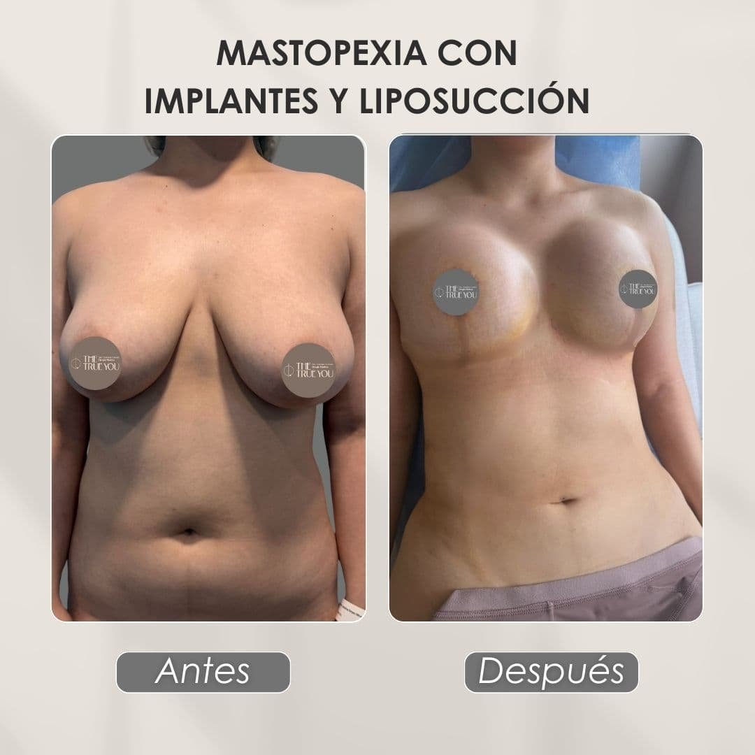 Mastopexia-con-implantes-y-liposuccion-antes-y-despues-con-la-Dra.-Daniela-Correa-de-Medellin-011225.jpg