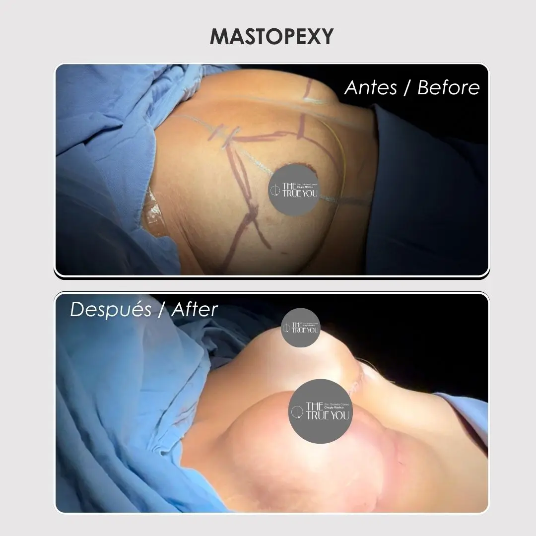 Mastopexy - colombian plastic surgery before and after - Dr. Daniela Correa 2