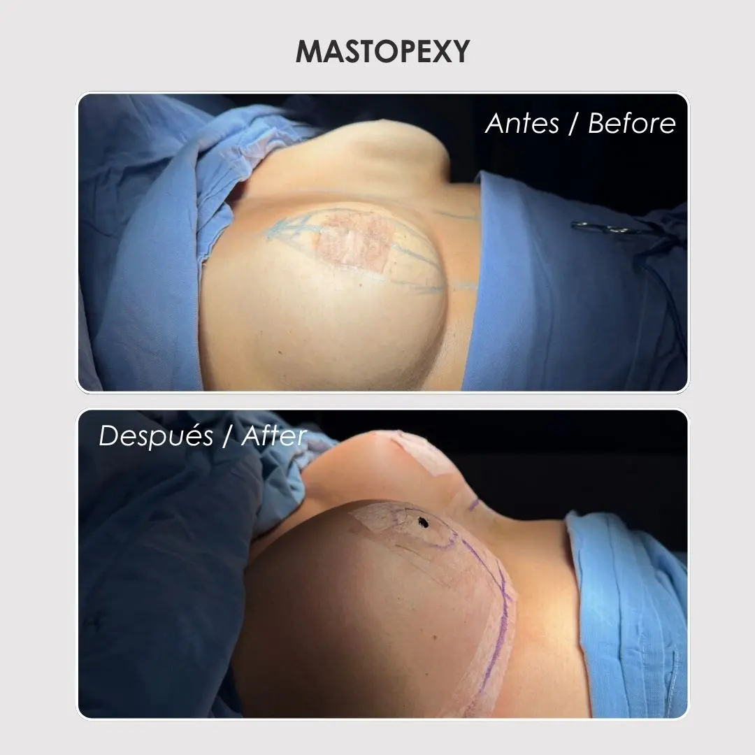 Mastopexy - colombian plastic surgery before and after - Dr. Daniela Correa 3