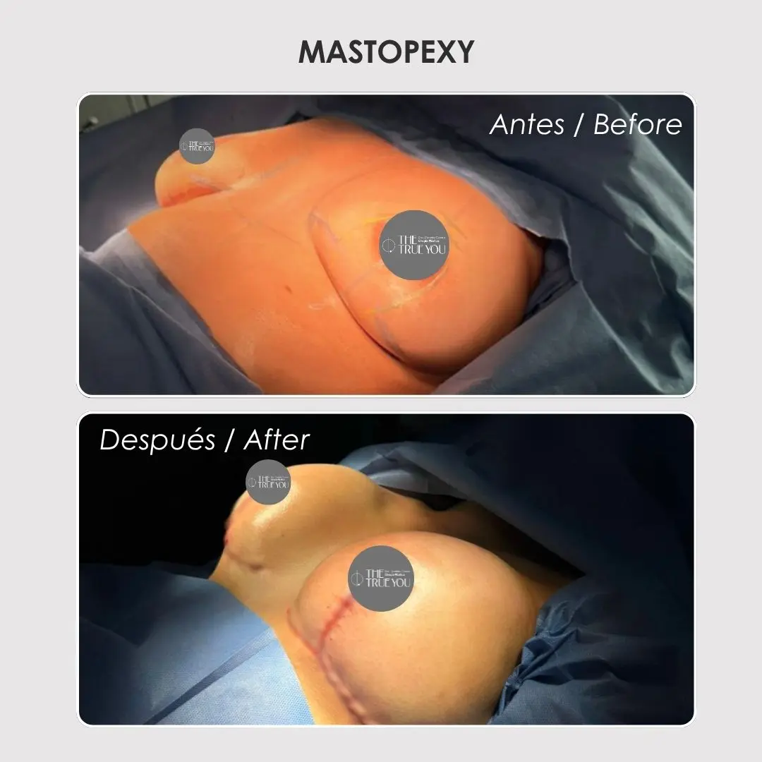 Mastopexy - colombian plastic surgery before and after - Dr. Daniela Correa 4