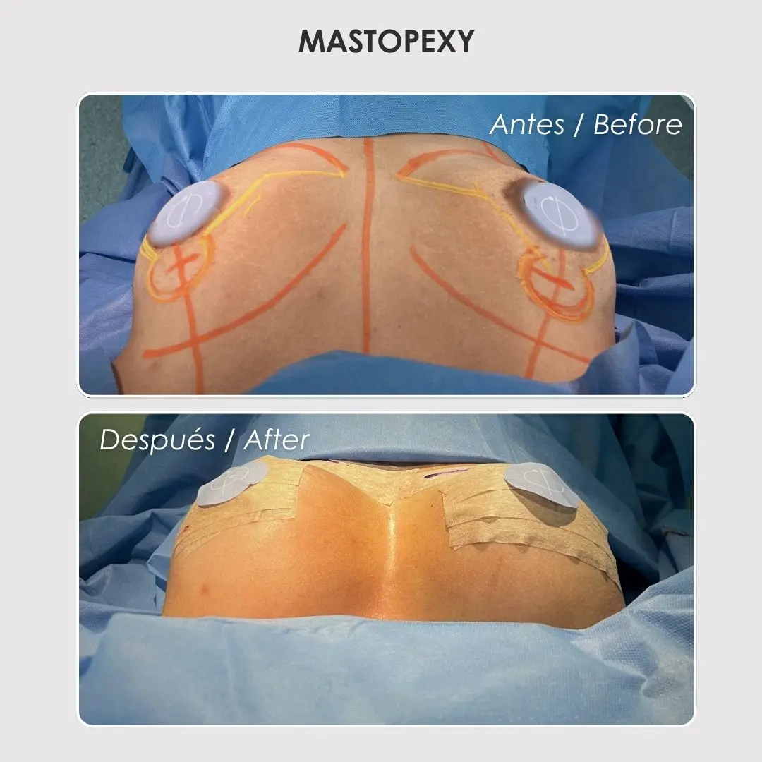 Mastopexy - colombian plastic surgery before and after - Dr. Daniela Correa 5