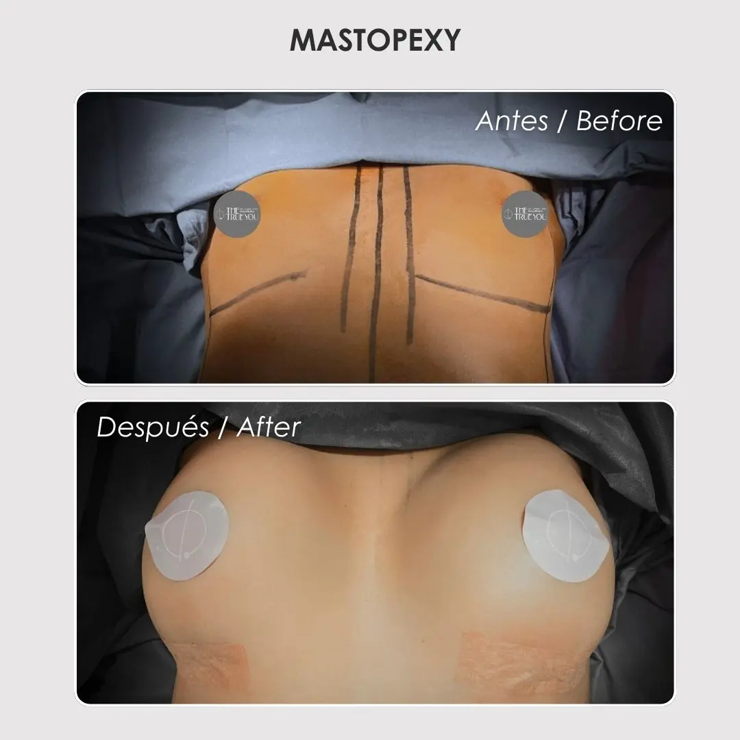 Mastopexy - colombian plastic surgery before and after - Dr. Daniela Correa 6