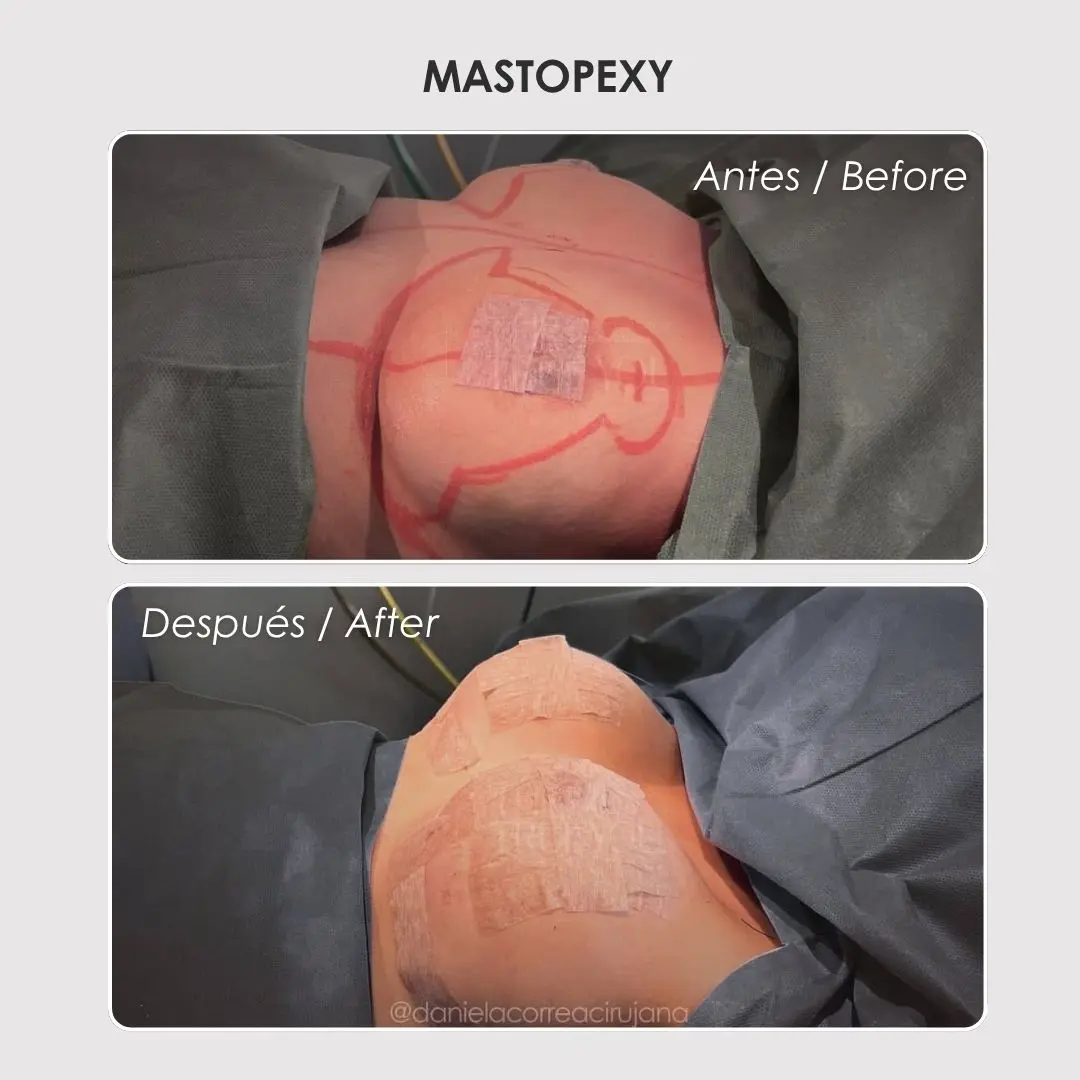 Mastopexy - colombian plastic surgery before and after - Dr. Daniela Correa 8