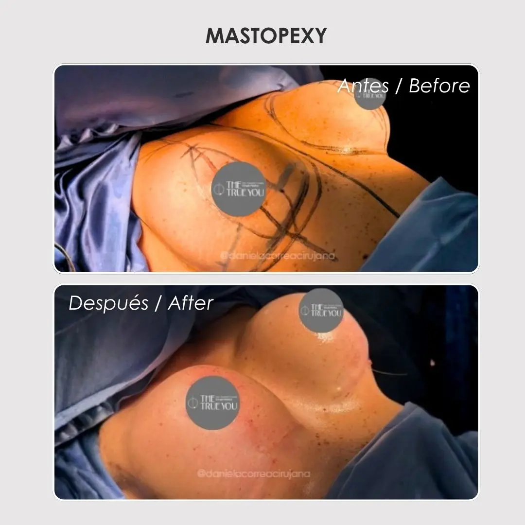 Mastopexy - colombian plastic surgery before and after - Dr. Daniela Correa