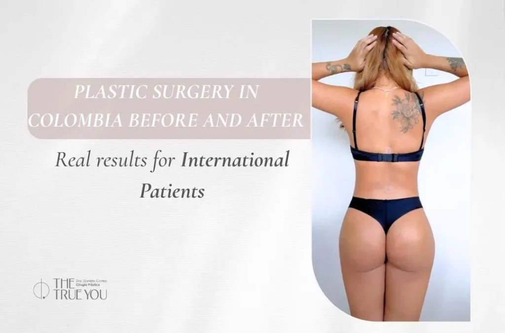 Plastic Surgery in Colombia Before and After Real Results for International Patients - Dr. Daniela Correa