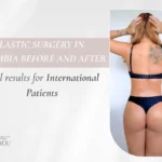 Plastic Surgery in Colombia Before and After Real Results for International Patients - Dr. Daniela Correa