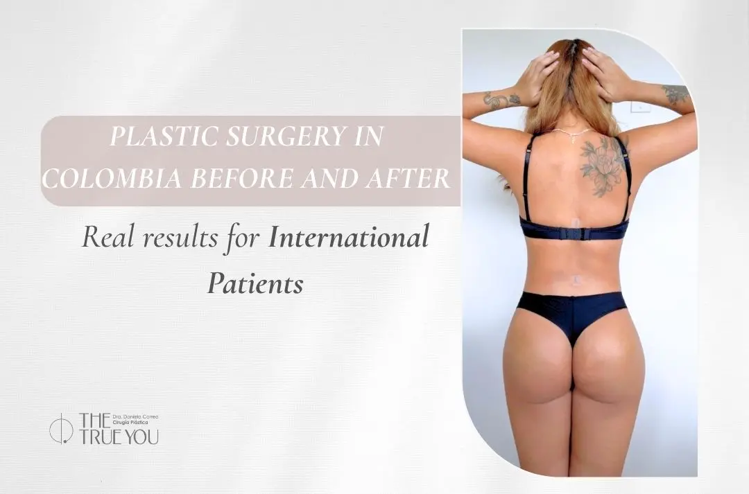 Plastic Surgery in Colombia Before and After Real Results for International Patients - Dr. Daniela Correa