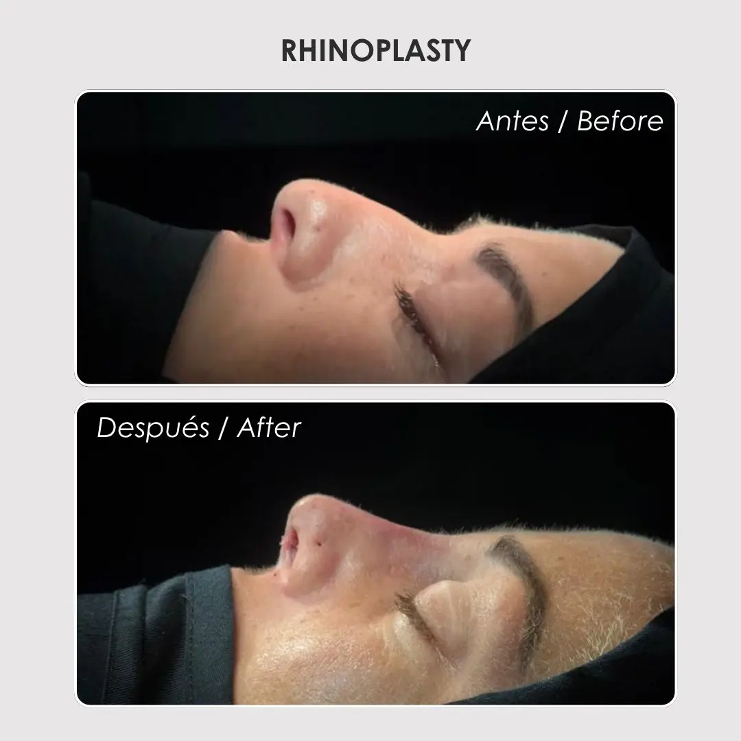 Rhinoplasty - colombian plastic surgery before and after - Dr. Daniela Correa 1