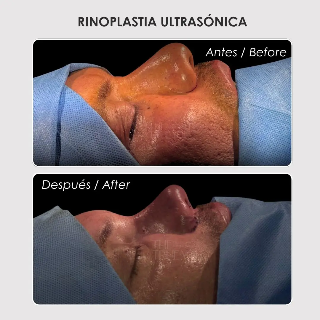 Rinoplastia ultrasónica antes y después con la cirujana plástica Daniela Correa - Medellín , Colombia- 060426
