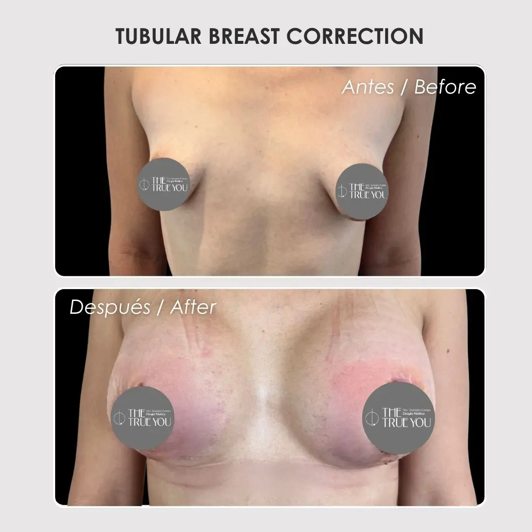 Tubular breast correction - colombian plastic surgery before and after - Dr. Daniela Correa 1
