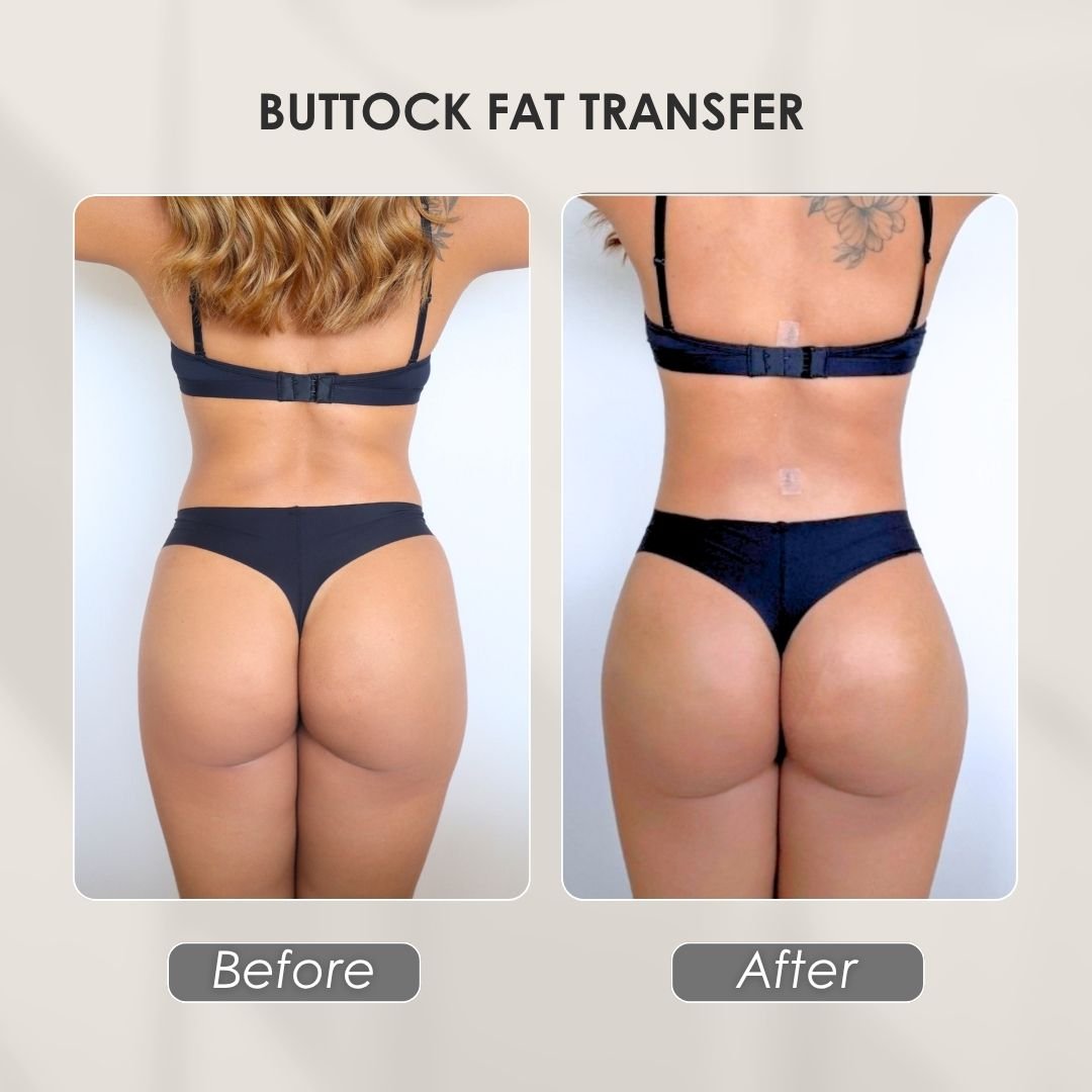 buttock fat transfer - colombian plastic surgery before and after - Dr. Daniela Correa 2