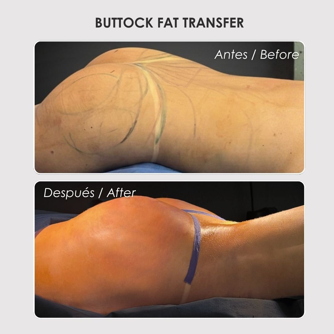 buttock fat transfer - colombian plastic surgery before and after - Dr. Daniela Correa