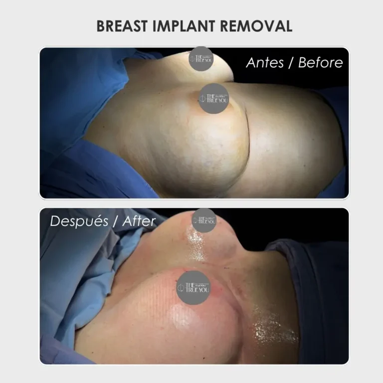 Breast implant removal before and after with Dr. Daniela Correa - Plastic surgeon in Medellín, Colombia - 300426