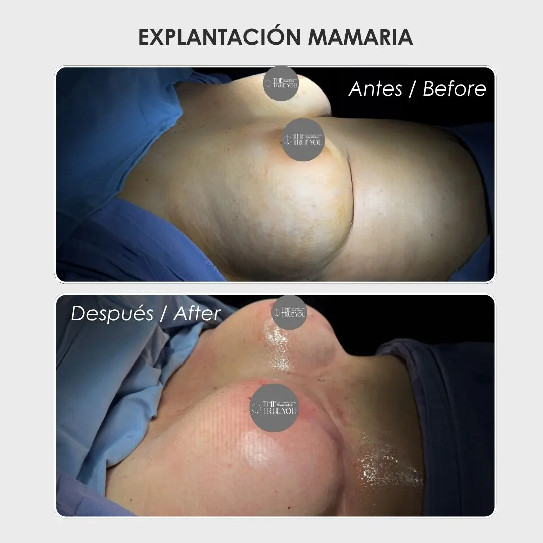 Explantación mamaria antes y después con la cirujana plástica Daniela Correa - Medellín , Colombia- 300426