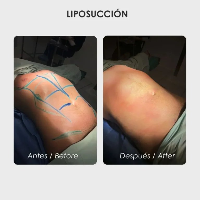 Liposucción en hombres antes y después con la cirujana plástica Daniela Correa - Medellín , Colombia