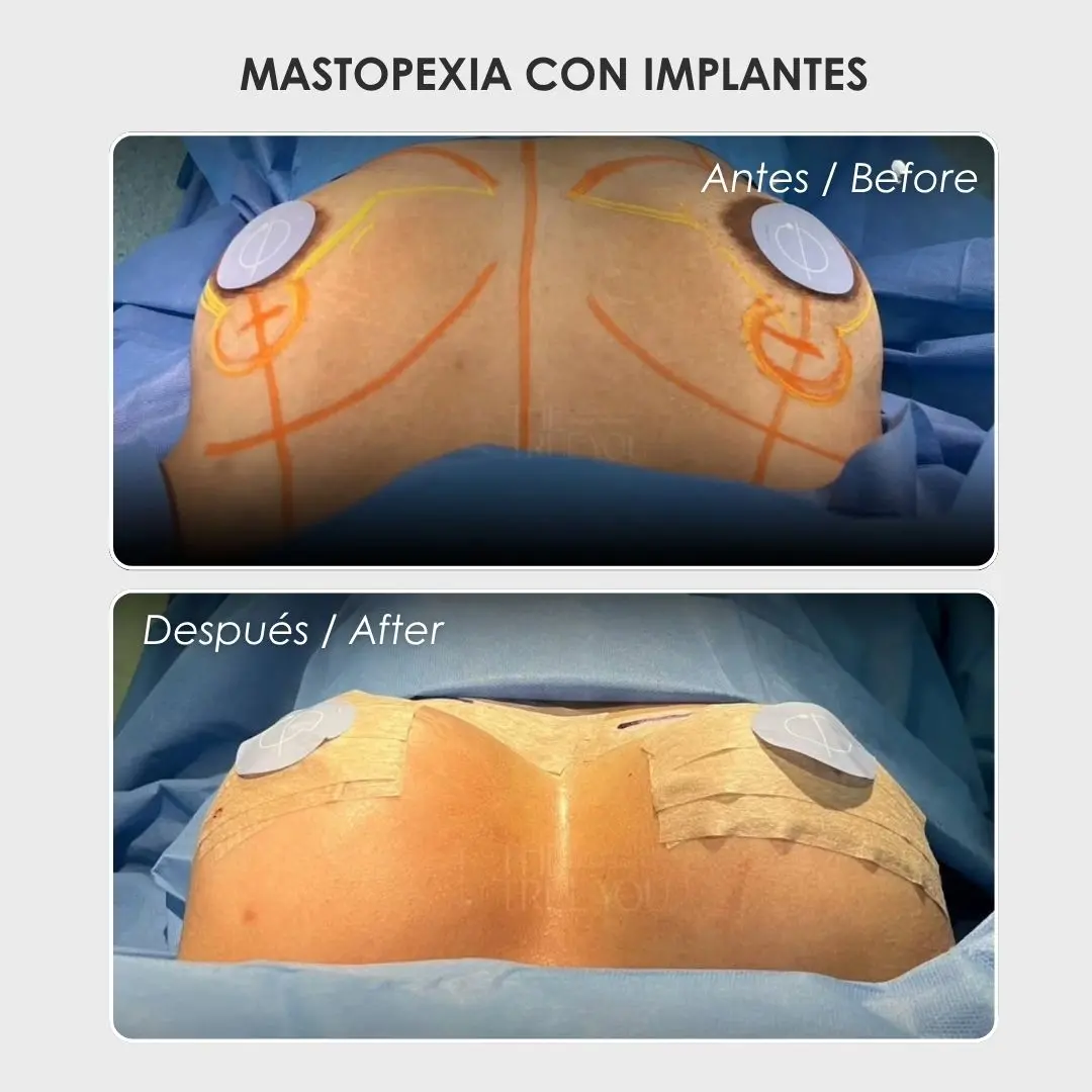 Mastopexia con implantes antes y después con la cirujana plástica Daniela Correa - Medellín , Colombia- 240426 1