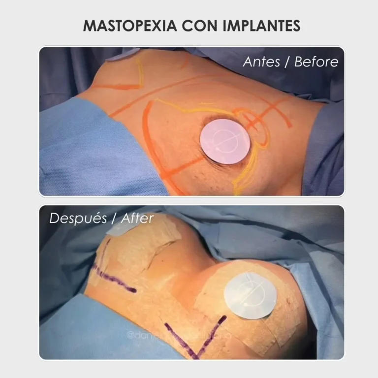 Mastopexia con implantes antes y después con la cirujana plástica Daniela Correa - Medellín , Colombia- 240426
