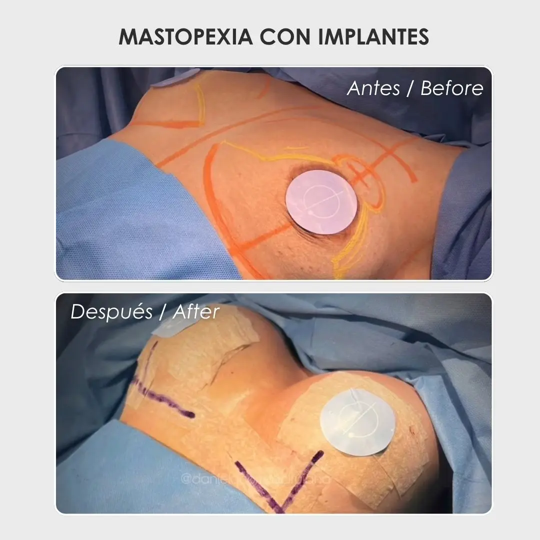 Mastopexia con implantes antes y después con la cirujana plástica Daniela Correa - Medellín , Colombia- 240426