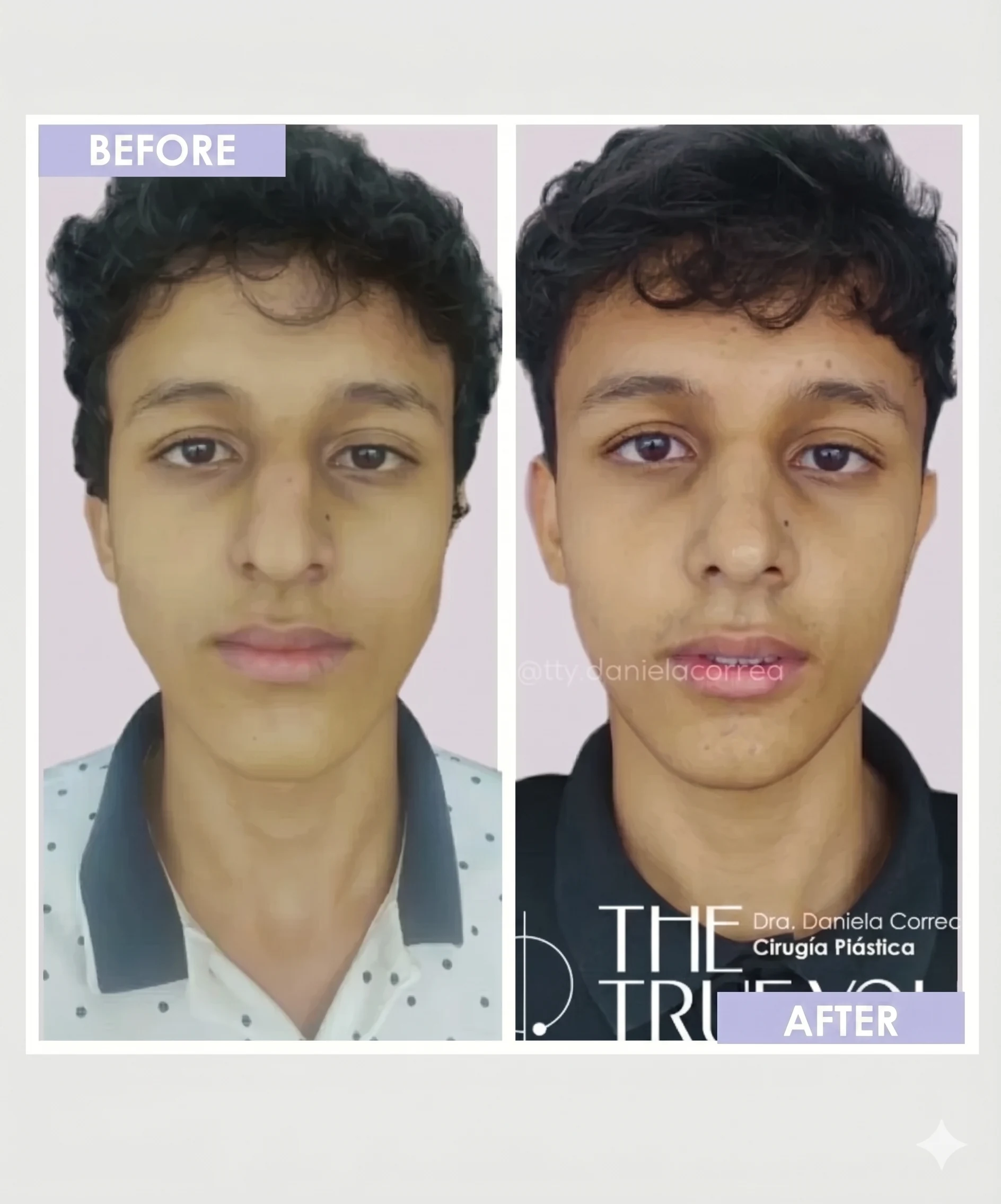Ultrasonic rhinoplasty before and after by Dr. Daniela Correa, Medellín — frontal view of same male patient showing nasal tip refinement and improved symmetry