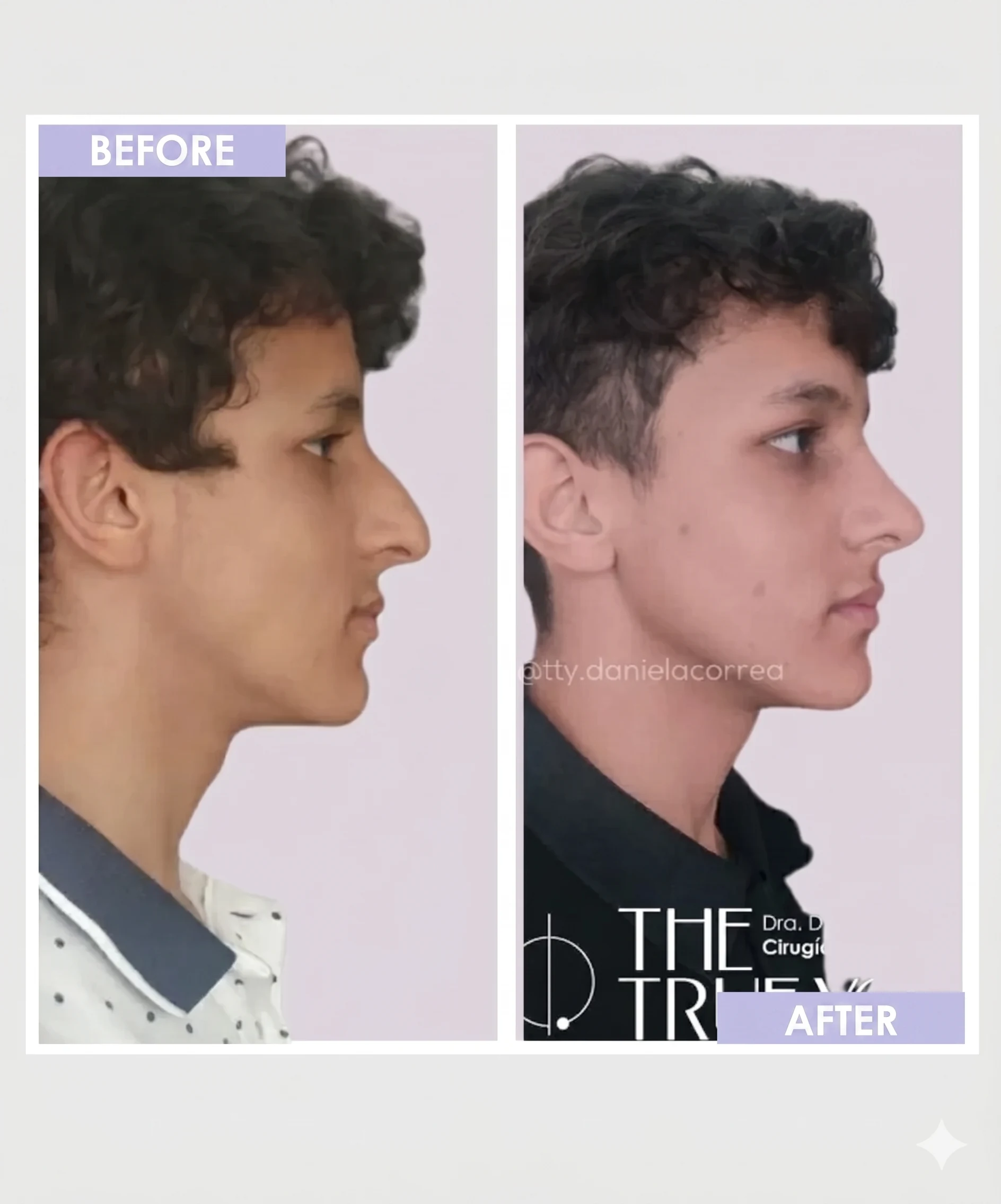 Ultrasonic rhinoplasty before and after by Dr. Daniela Correa, Medellín — profile view of male patient showing dorsal hump refinement and improved tip projection