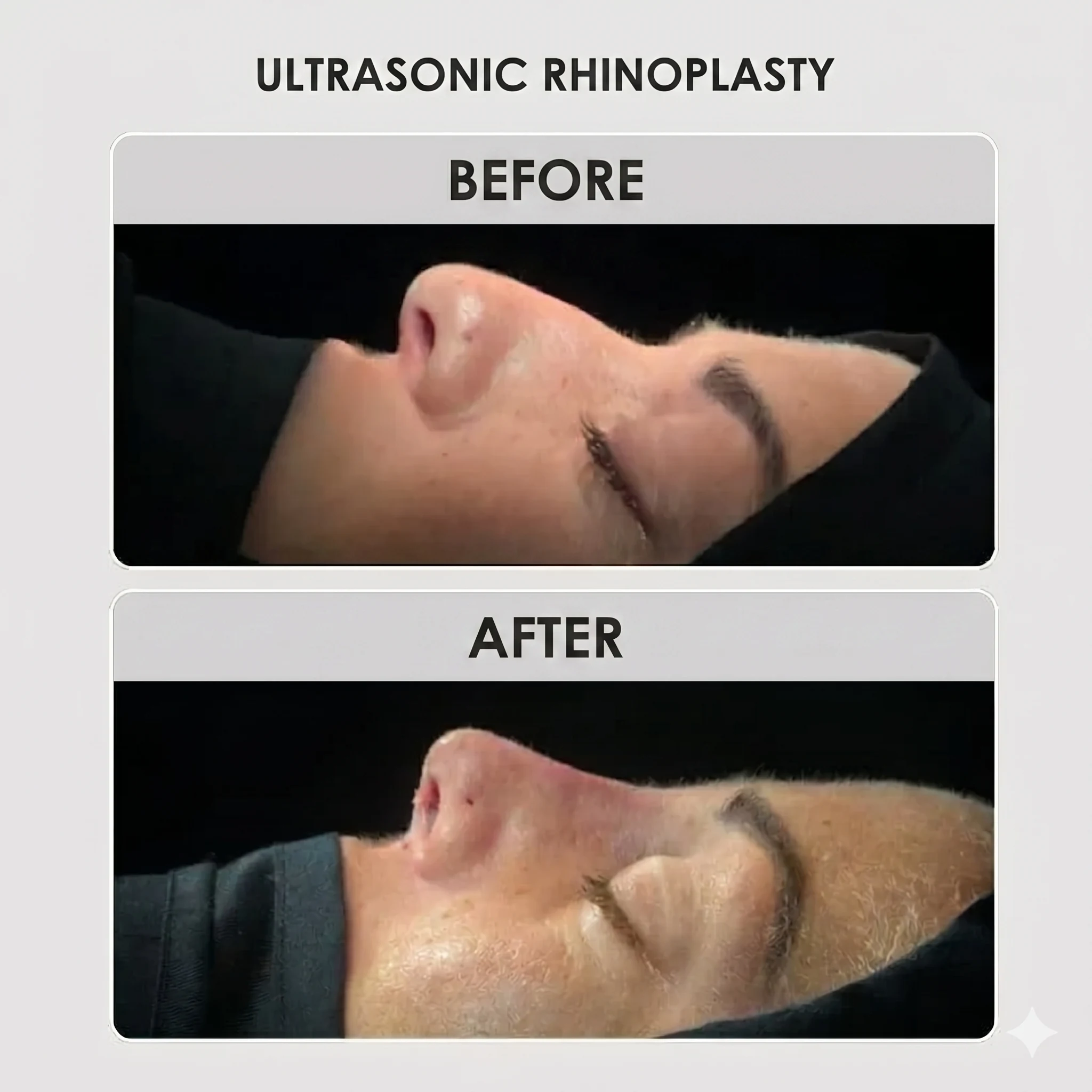Ultrasonic rhinoplasty before and after by Dr. Daniela Correa, Medellín — profile view of female patient showing dorsal hump correction and refined tip
