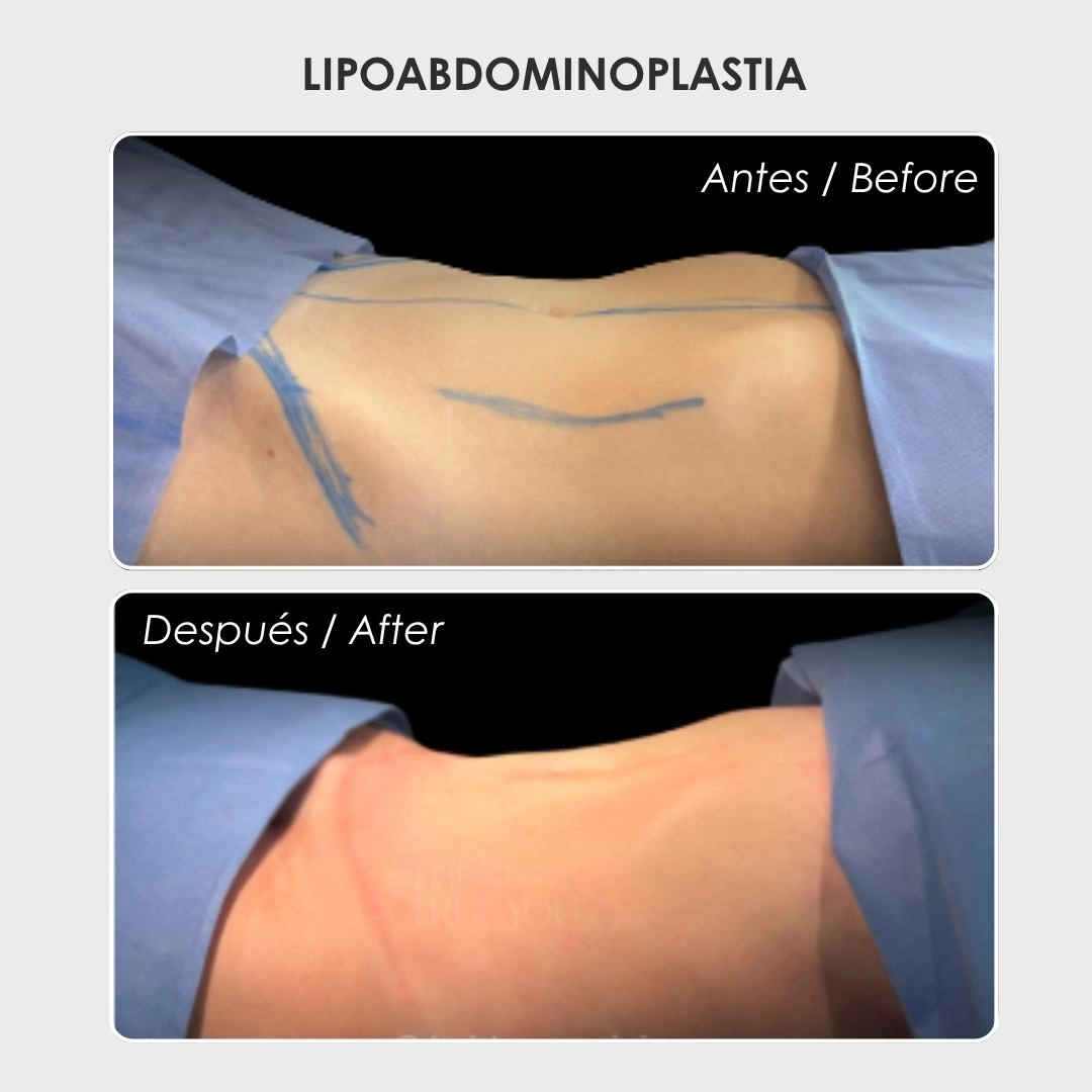Lipoabdominoplastia con la Dra. Daniela Correa - Cirujana PLástica en Medellín