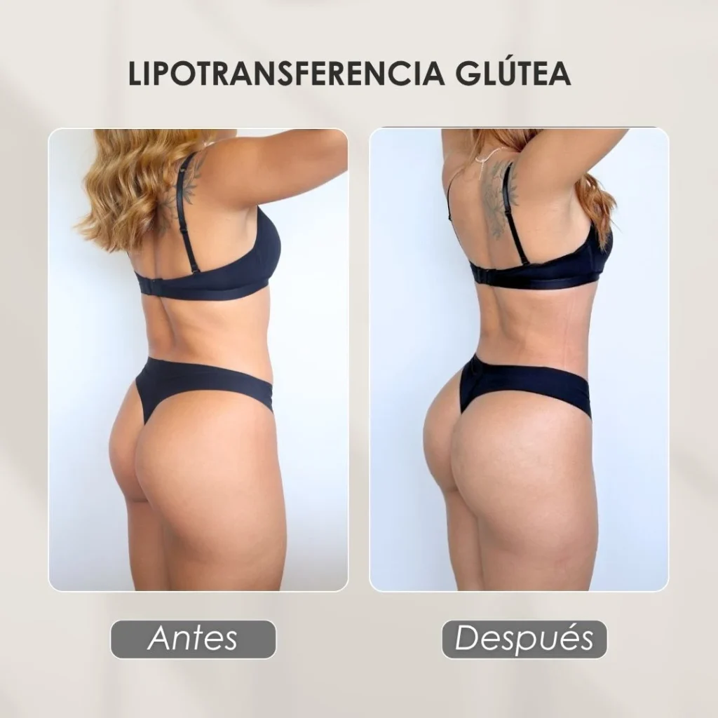 Lipotransferencia glútea con la Dra. Daniela Correa - Cirujana Plástica en Medellín