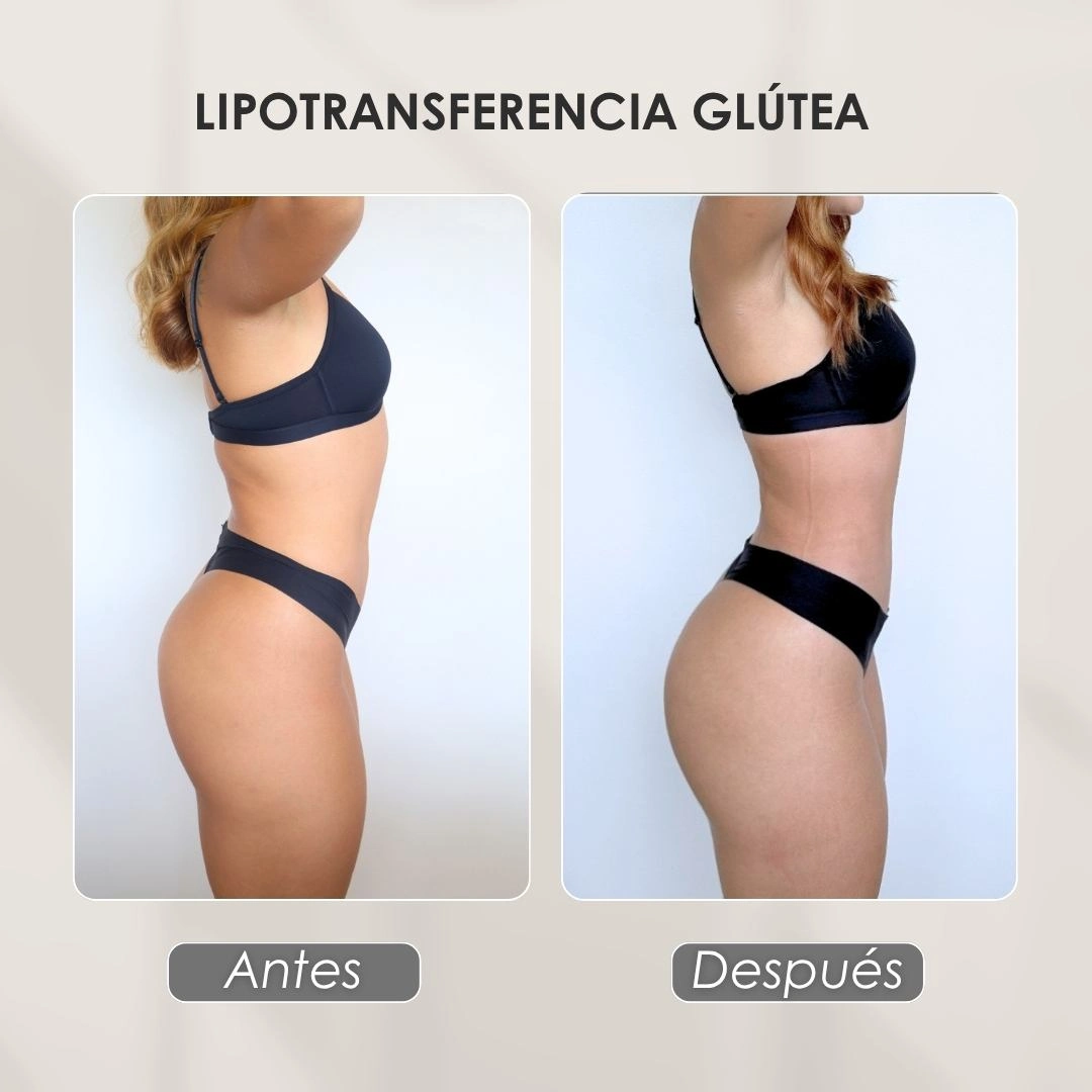 Lipotransferencia glútea con la Dra. Daniela Correa - Cirujana