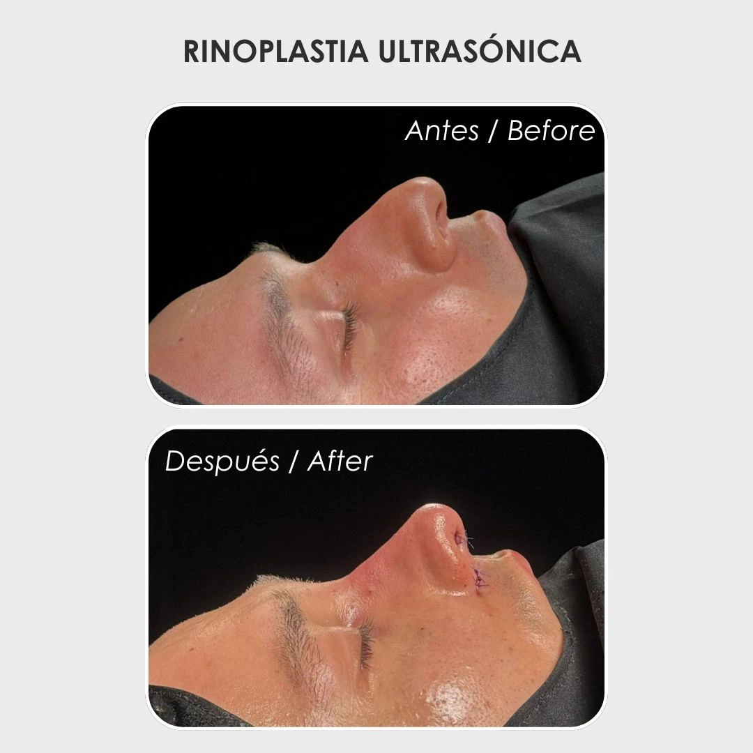 Rinoplastia ultrasónica con la Dra. Daniela Correa -Cirujana Plástica