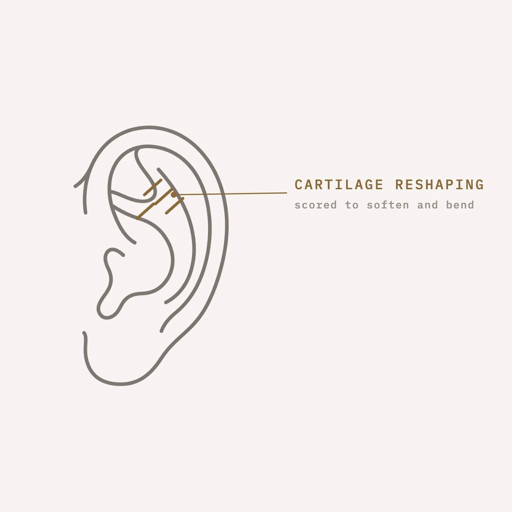 Diagram: cartilage scoring to reshape stiff ear cartilage in otoplasty — Dr. Daniela Correa, Medellín