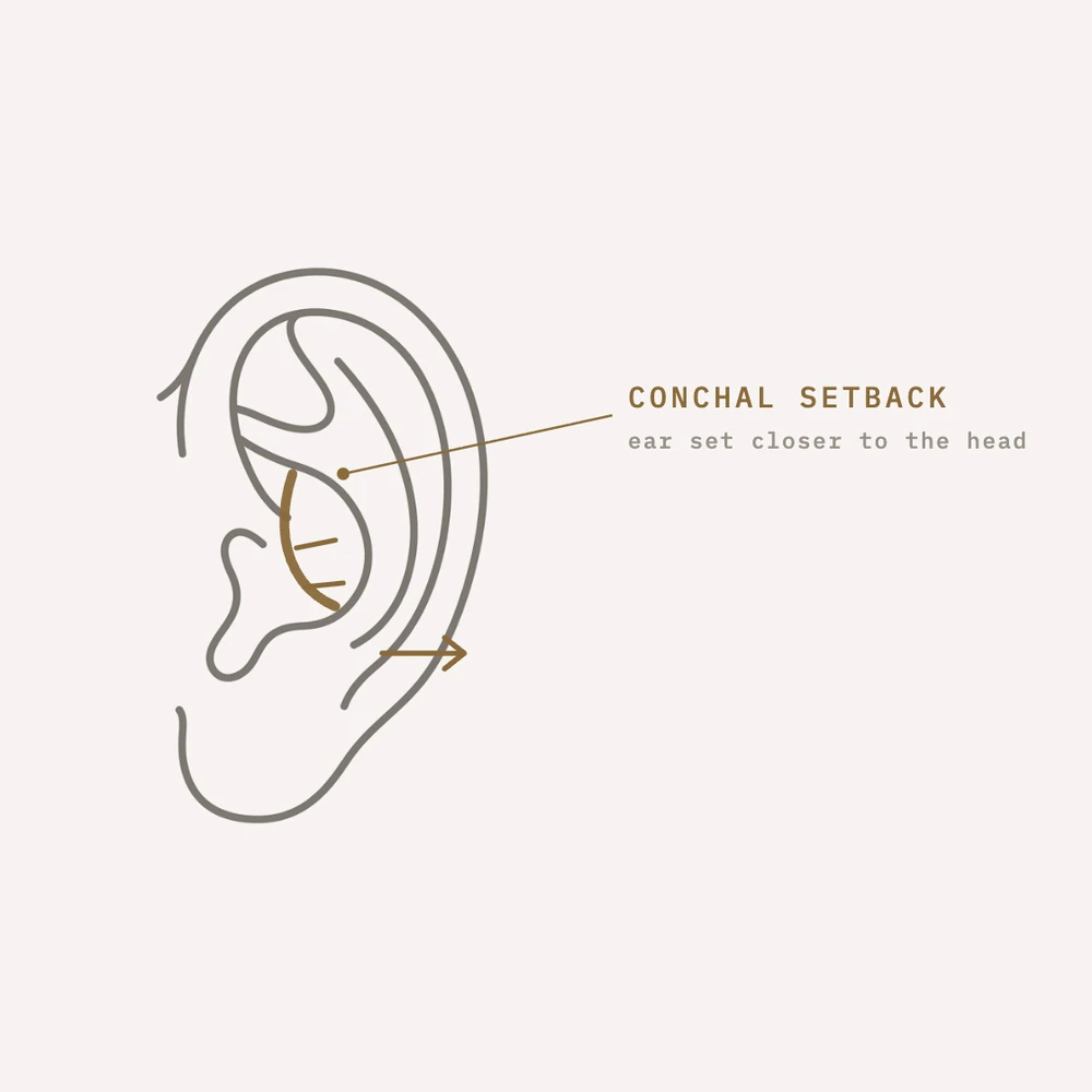 Diagram: conchal setback bringing the ear closer to the head in otoplasty — Dr. Daniela Correa, Medellín