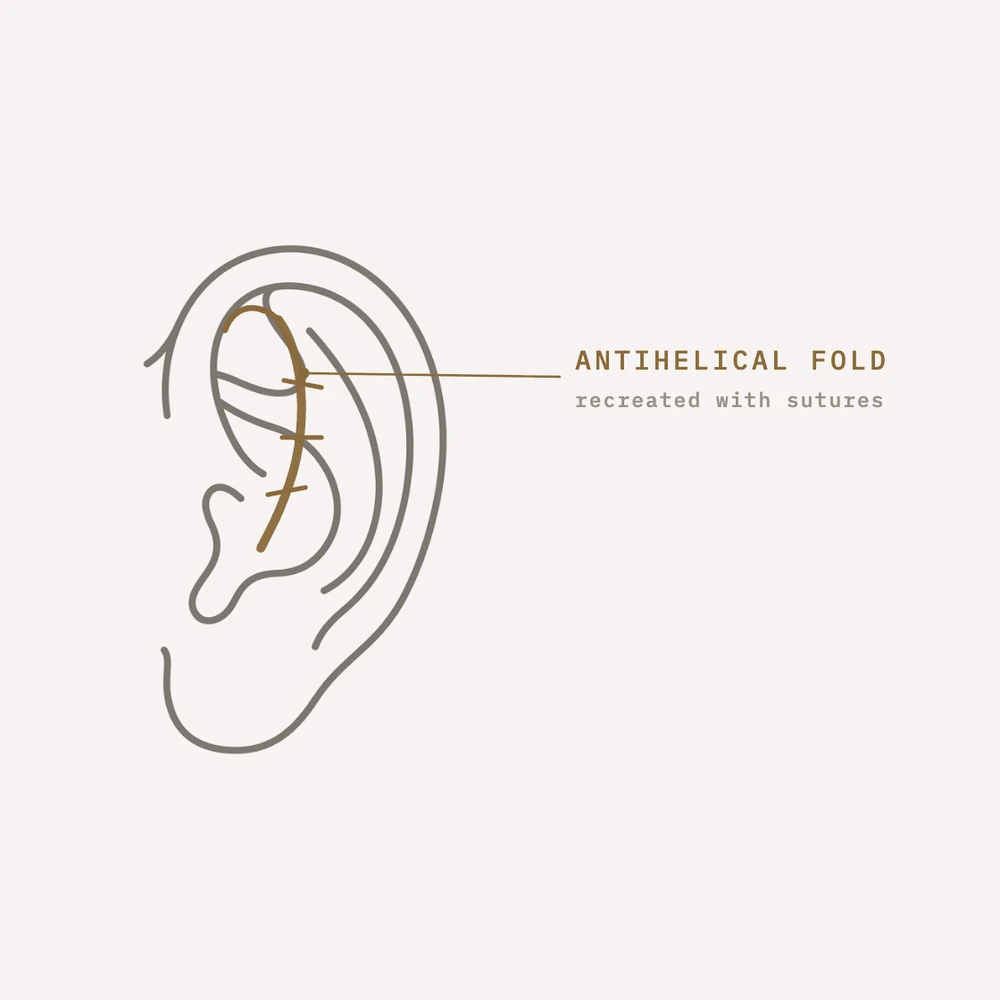 Diagram: Mustardé sutures recreating the antihelical fold in otoplasty — Dr. Daniela Correa, Medellín