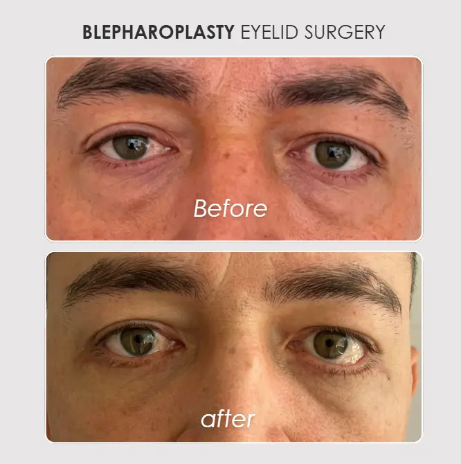 Best plastic surgery Medellin Colombia- Dra. Daniela Correa- Before and after Blepharoplasty