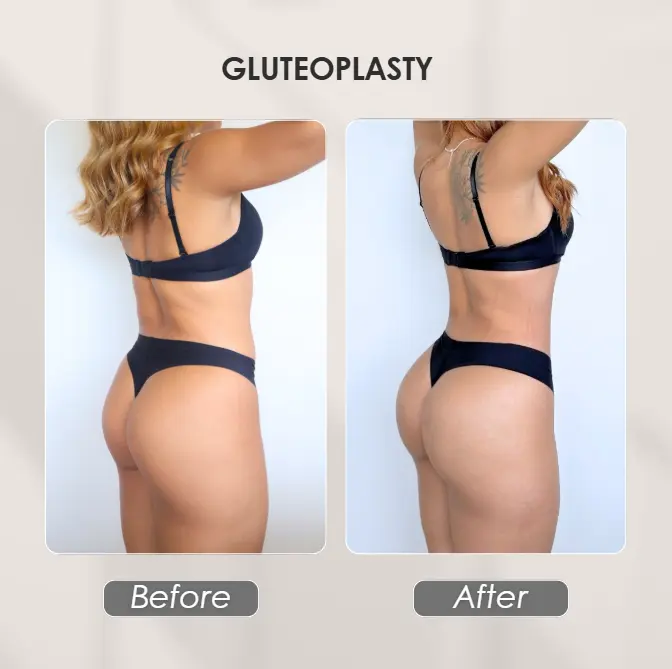 Best plastic surgery in Medellin Colombia- Dra. Daniela Correa- Before and after Gluteoplasty