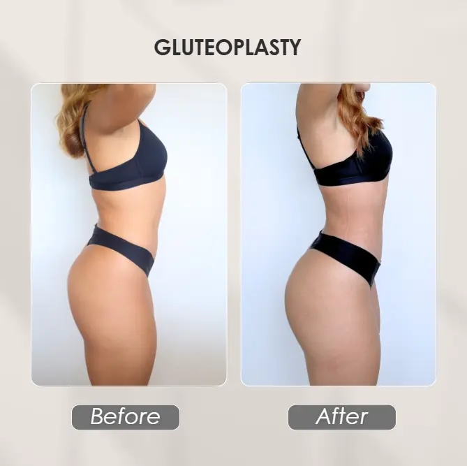 Best plastic surgery in Medellin Colombia- Dra. Daniela Correa- Before and after Gluteoplasty