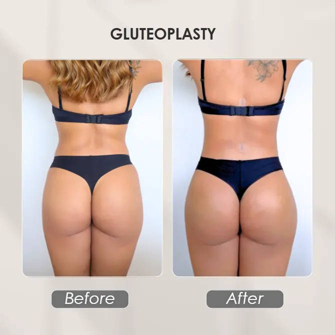 Best plastic surgery in Medellin Colombia- Dra. Daniela Correa- Before and after Gluteoplasty