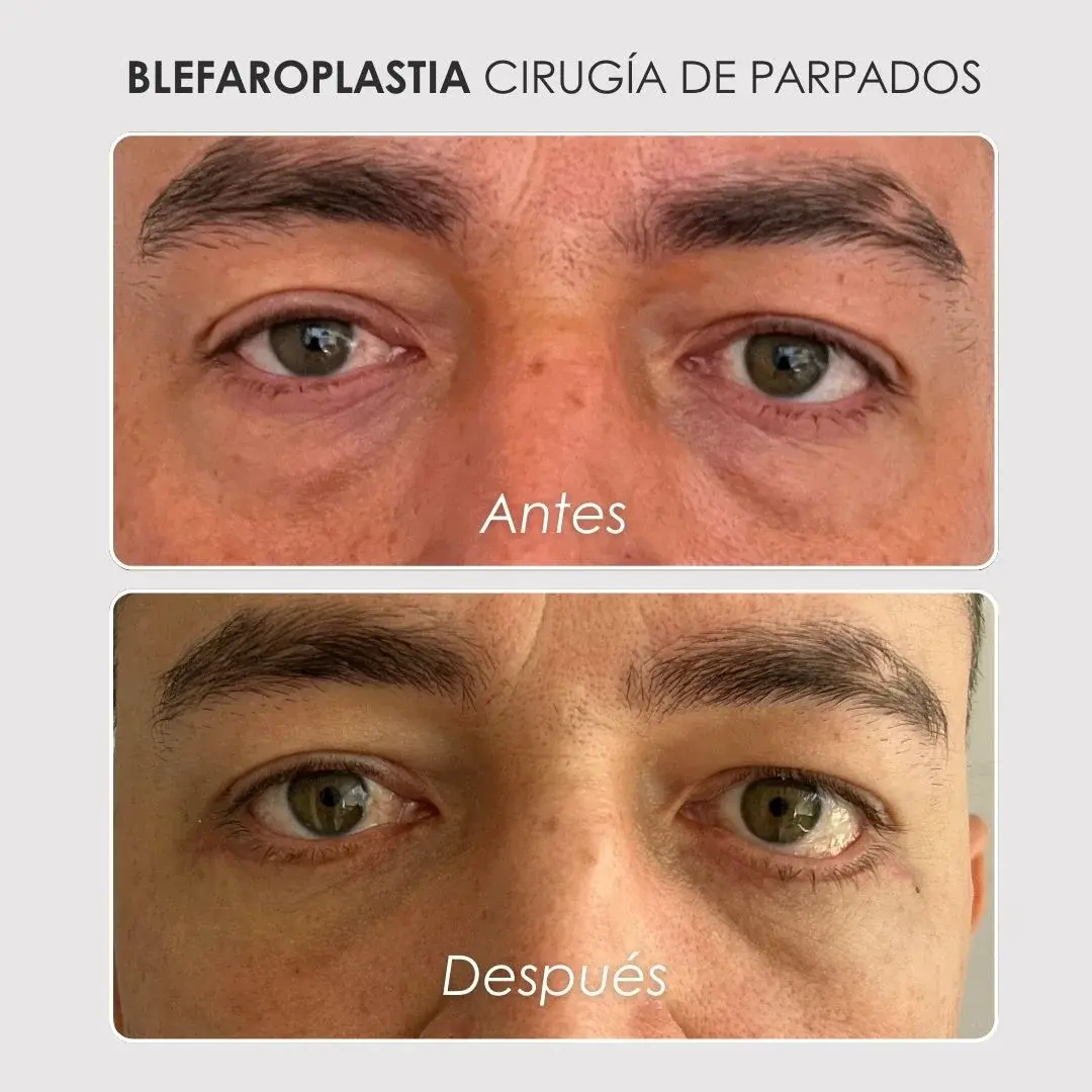 Best plastic surgery in Medellin Colombia- Dra. Daniela Correa- Before and after Blepharoplasty
