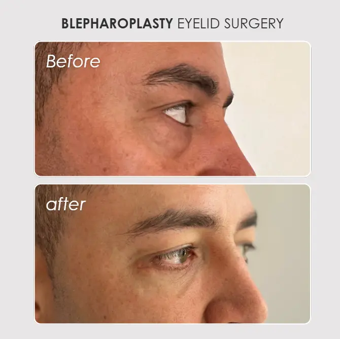 Best plastic surgery in Medellin Colombia- Dra. Daniela Correa- Before and after Blepharoplasty