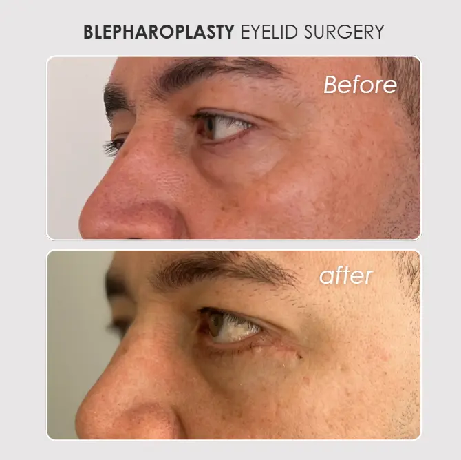 Best plastic surgery in Medellin Colombia- Dra. Daniela Correa- Before and after Blepharoplasty