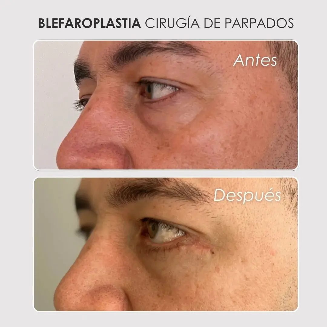 Best plastic surgery in Medellin Colombia- Dra. Daniela Correa- Before and after Blepharoplasty