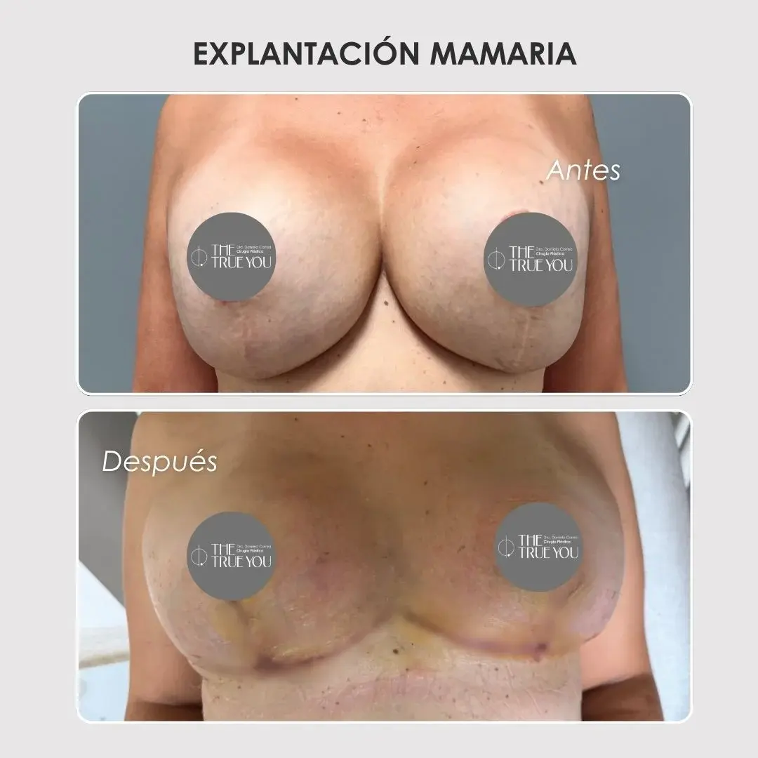 Best plastic surgery in Medellin Colombia- Dra. Daniela Correa- Before and after Breast Surgery