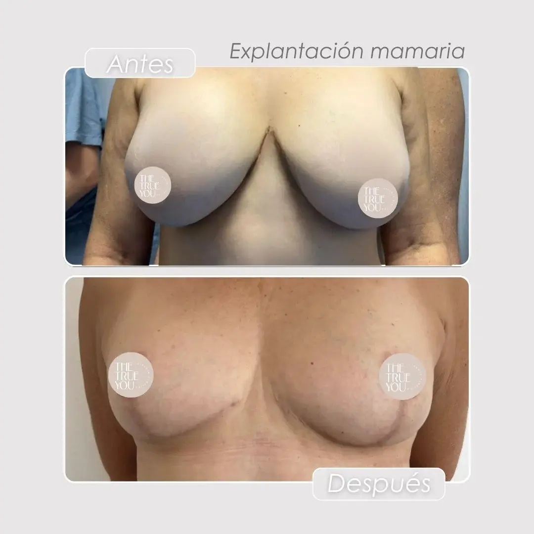 Best plastic surgery in Medellin Colombia- Dra. Daniela Correa- Before and after Breast Surgery