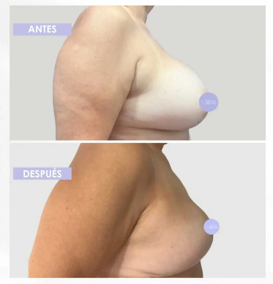 Best plastic surgery in Medellin Colombia- Dra. Daniela Correa- Before and after Breast Surgery